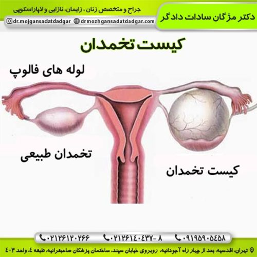کیست تخمدان - دکتر دادگر