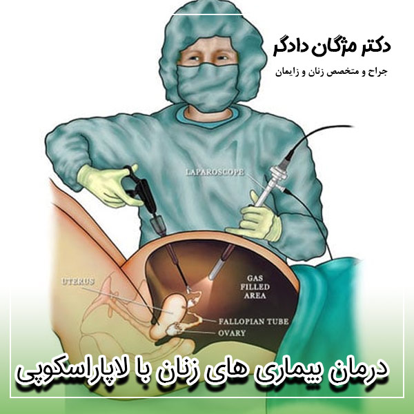 درمان بیماری های زنان با لاپاراسکوپی - دکتر دادگر