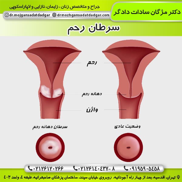 سرطان رحم - دکتر دادگر 