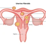 فیبروم رحم چیست و چرا با ناباروری ارتباط دارد؟