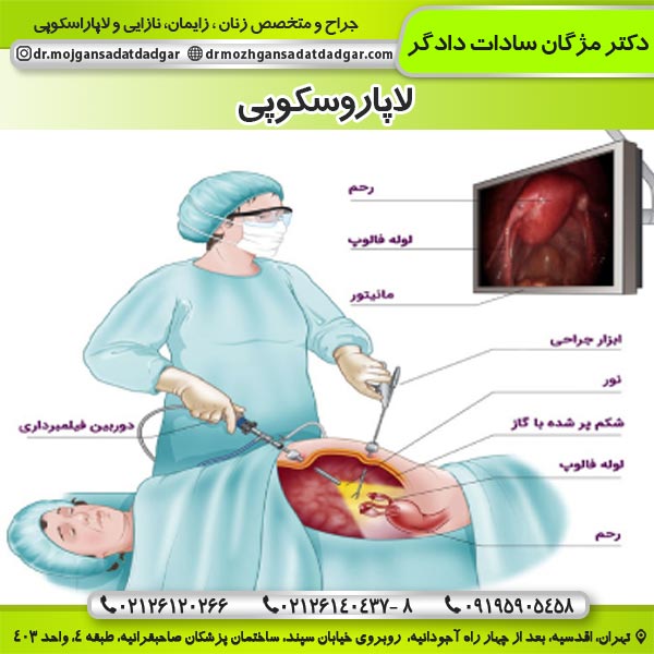 لاپاروسکوپی در تهران - دکتر دادگر